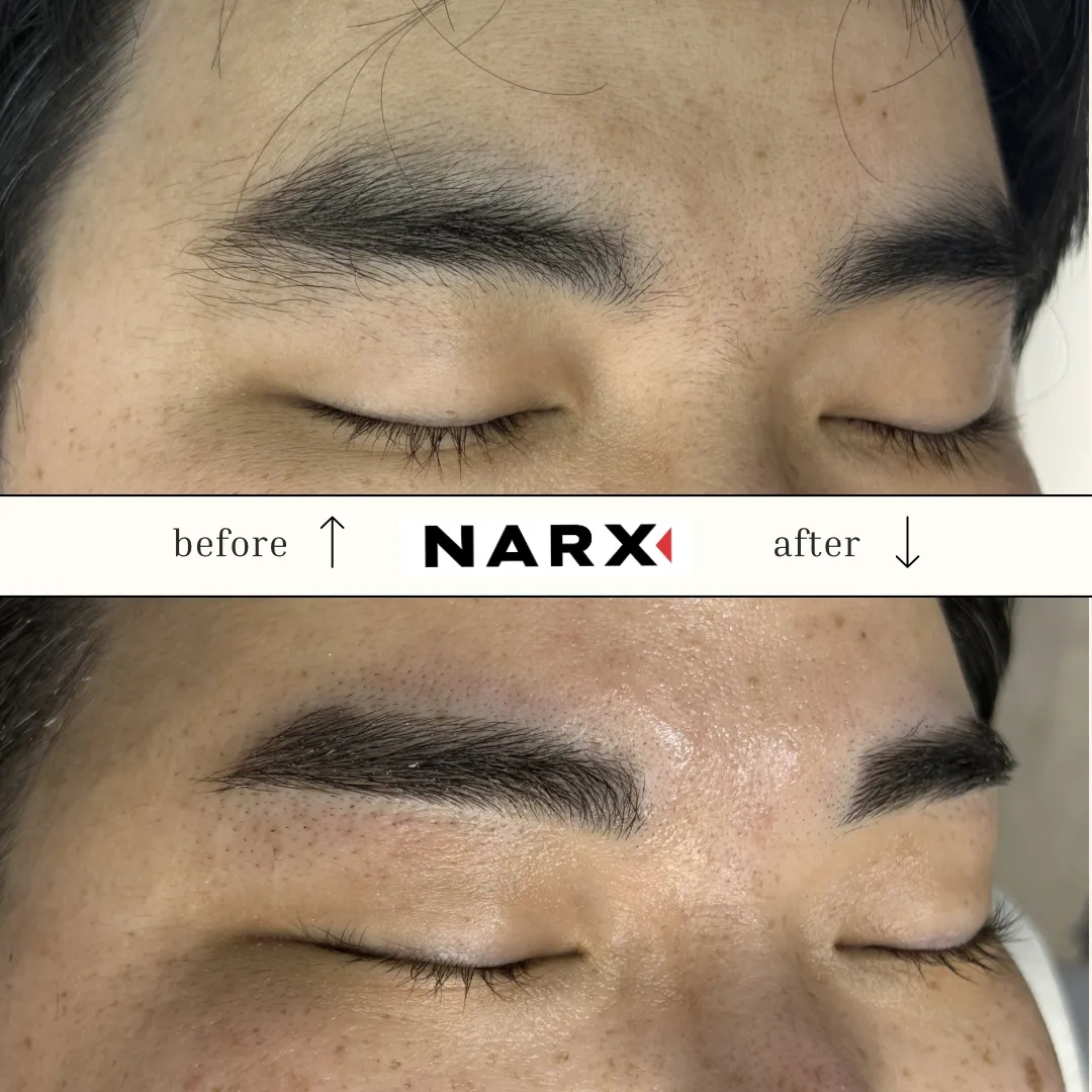 メンズ眉毛 光脱毛のビフォーアフター例 3