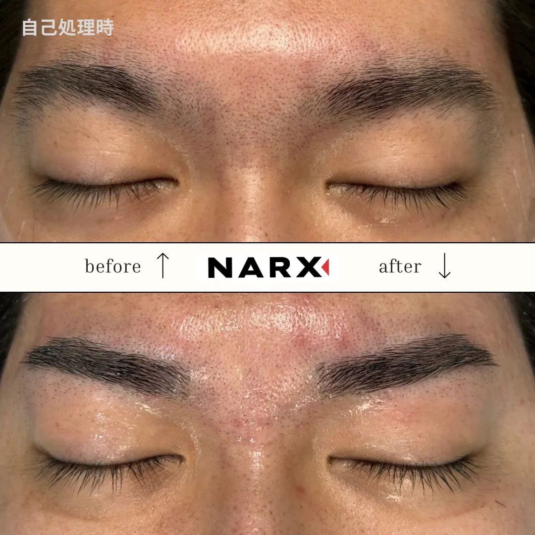 メンズ眉毛 光脱毛のビフォーアフター例 6