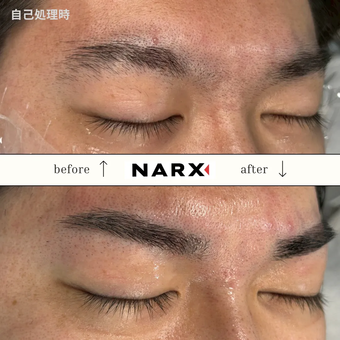 メンズ眉毛 光脱毛のビフォーアフター例（before / after）